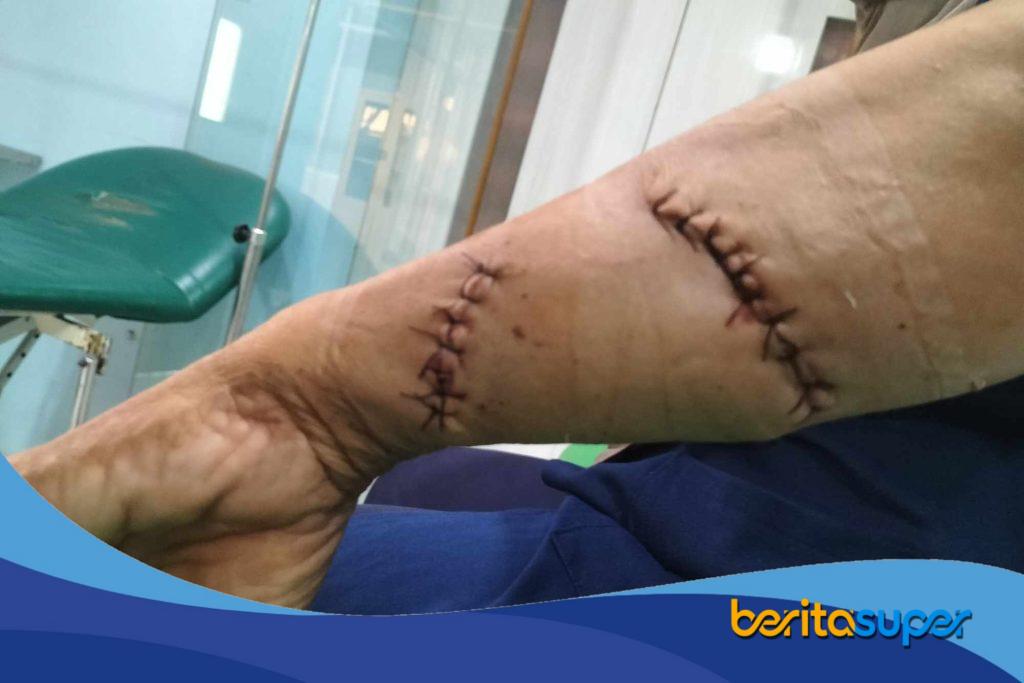 Foto luka robek pada tangan kanan