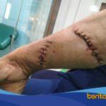 Foto luka robek pada tangan kanan